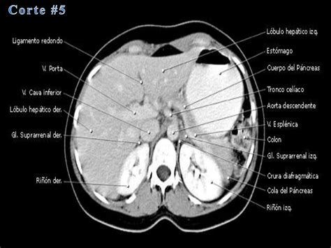 Tomografia axial computarizada (abdominal)