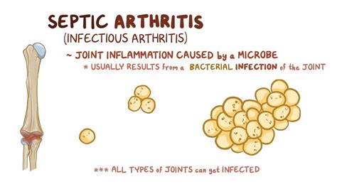 Septic arthritis: Video, Anatomy, Definition & Function | Osmosis