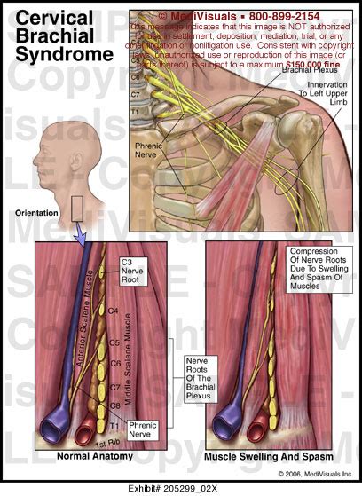 Cervical Brachial Syndrome Medical Illustration Medivisuals