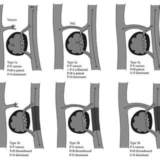 Different sites of portosystemic anastomosis which can form varices. 1 ...