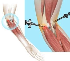 Elbow Arthroscopy Stamford CT | Tennis Elbow Surgery Westchester NY