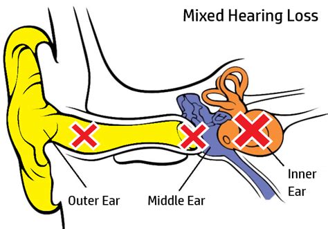 Why Can’t I Hear? Types and Causes of Hearing Loss You Need to Know