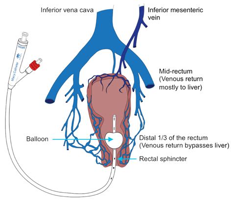 Skilled Nursing Facility - The Macy Catheter