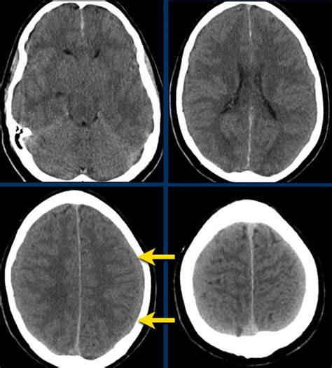 Subdural Hematoma Mri