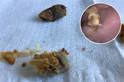 Medic discovers giant lump of dried wax matted with hair blocking man's ear