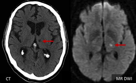 Lacunar stroke | STROKE MANUAL