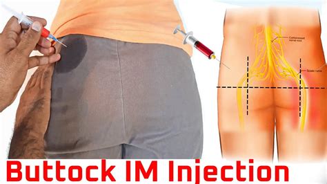 How to give an intermuscular (IM) injection in gluteal muscle at home buttock injection ...