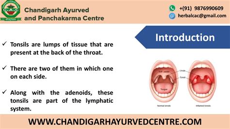 PPT - How To Treat Tonsillitis Through Ayurveda? PowerPoint ...