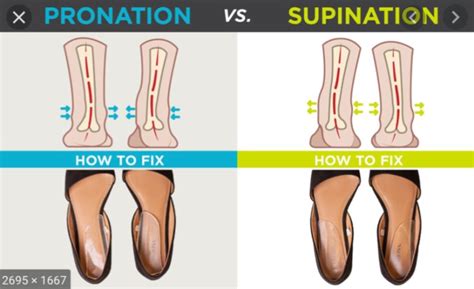 Onderpronatie (supinatie) voet - hoe los je het op? - Medical Massages