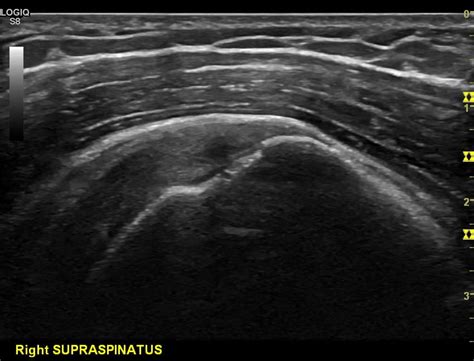 Long axis view of the Supraspinatus tendon and hypoechoic defect of an articular surface defect