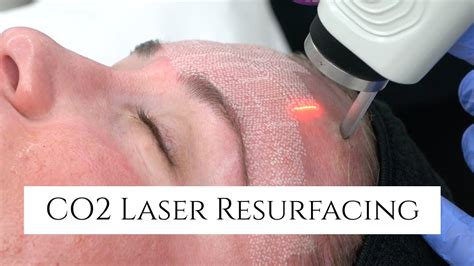 CO2 Laser Facial Rejuvenation | Fix Fine Lines and Wrinkles | Fix Sun ...