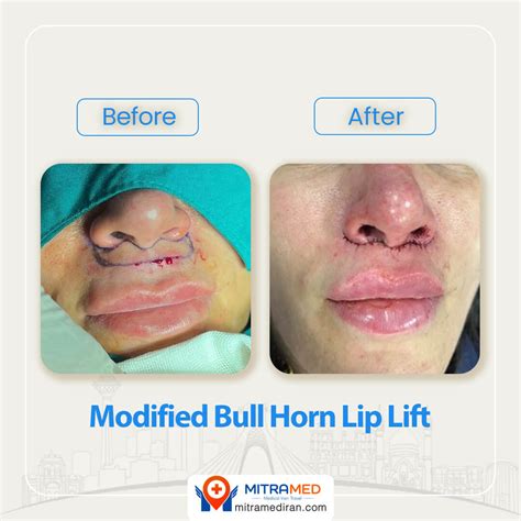 Lip Lift in Iran | Lip Surgery Cost, Results | MITRAMED