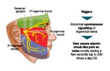 Trigeminal Neuralgia Treatment, Symptoms, What is, Surgery, Causes