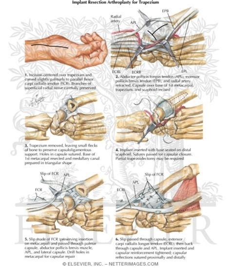 Trapezium Implant Resection Arthroplasty for Thumb Disabilities