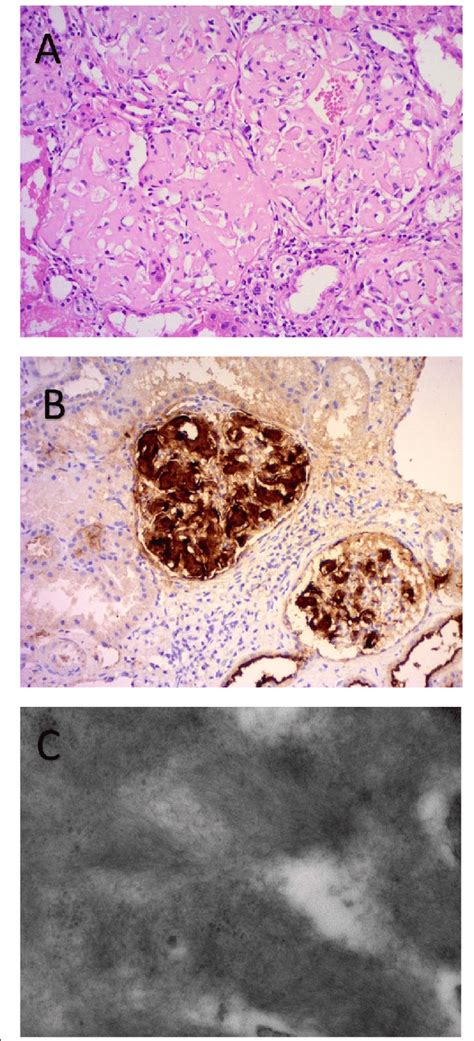 Histology of renal amyloidosis. a H&E stain shows extensive effacement ...