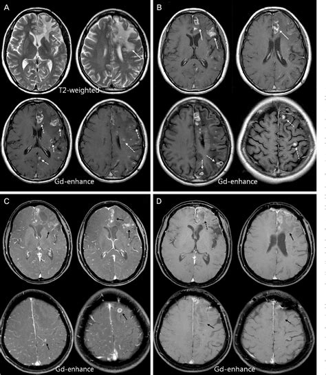 Figure 1 from Primary Angiitis of the Central Nervous System Presenting ...