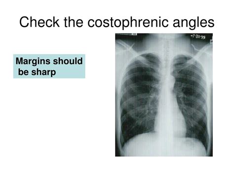 PPT - Basic Chest X-Ray Interpretation PowerPoint Presentation, free download - ID:1033643