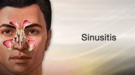 HIE Multimedia - Sinusitis in adults - aftercare