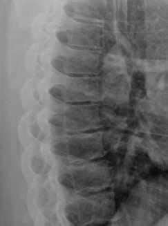 Thoracic Spine Xray