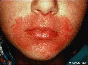 The New York Times > Health > Image > Candidiasis, Cutaneous - Around the Mouth