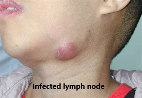 Lymph node in children | Dr Joann Child Specialist