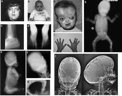 Pfeiffer syndrome *Gene map locus 10q26, 8p11.2-p11.1 ACS V ACS5 Acrocephalosyndactyly, type V ...