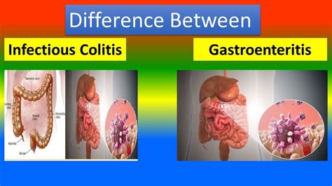 Infectious Colitis