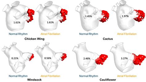 Left Atrial Appendage Morphology Types