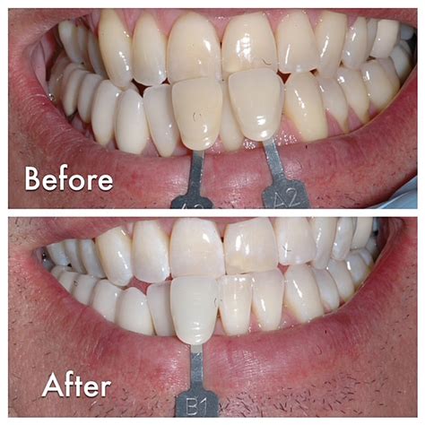 Laser Teeth Whitening in North Scottsdale, AZ | Laser Dentistry