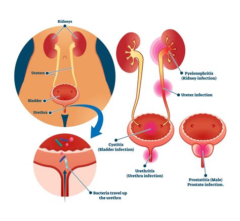 Urinary Tract Infection (UTI) Treatment in Singapore - Aare Urocare