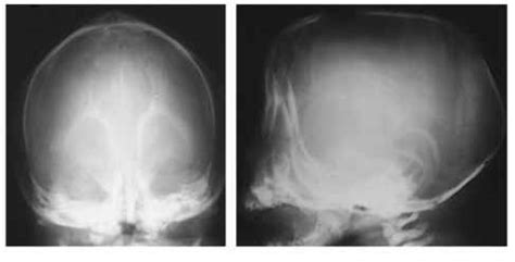 Carpenter Syndrome Pictures - Newborns - RR School Of Nursing