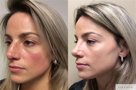 Rhinoplasty Before and After Pictures Case 349 | Albany, Latham & Saratoga, New York | Rockmore ...