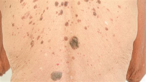 Age & Liver Spots: Symptoms, Causes, & Treatment - Toronto Dermatology ...