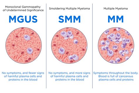 Multiple Myeloma | Memorial Sloan Kettering Cancer Center