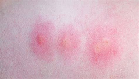 Identifying Common Insect Bites and Stings | Sentinel Blog