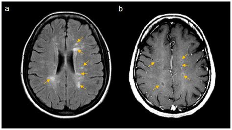 IJMS | Free Full-Text | What Do Effective Treatments for Multiple Sclerosis Tell Us about the ...