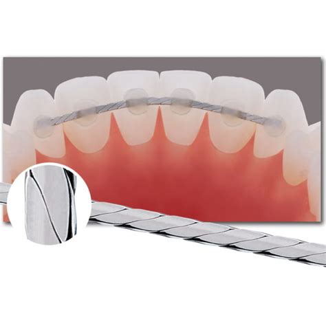 Flat Titanium Dead-Soft Lingual Retainer Wire | Value-Rx, Inc.