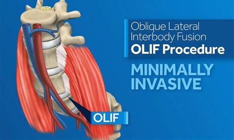 Understanding Oblique Lateral Interbody Fusion (OLIF) Surgery - Spine Connection