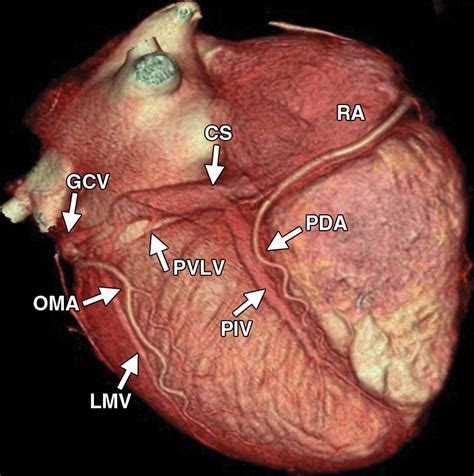 Imaging of the Coronary Sinus: Normal Anatomy and Congenital ...