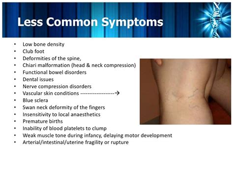 Pin on EDS, fibromyalgia, CFS