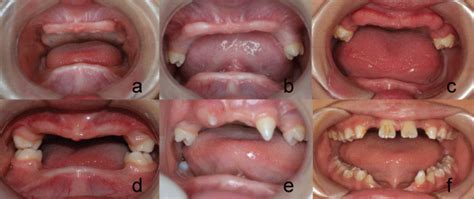 Ectodermal Dysplasia Teeth