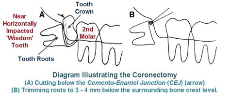 Coronectomy – Exodontia