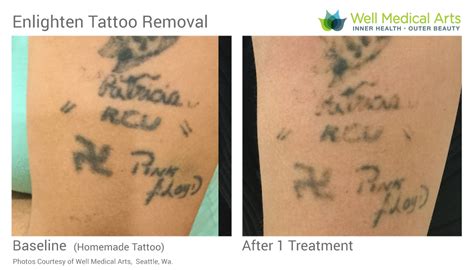 Laser Tattoo Removal with the Cutera Enlighten in Seattle at Well Medical Arts. Call 206-935 ...