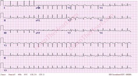 Atrial Fibrillation with RVR ECG 3 | LearntheHeart.com