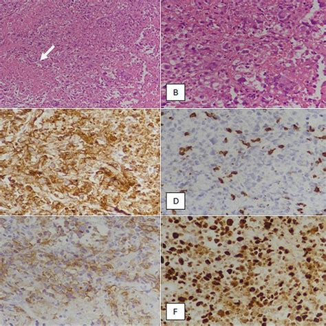 (PDF) CD30-Positive Anaplastic Variant of Diffuse Large B-cell Lymphoma ...