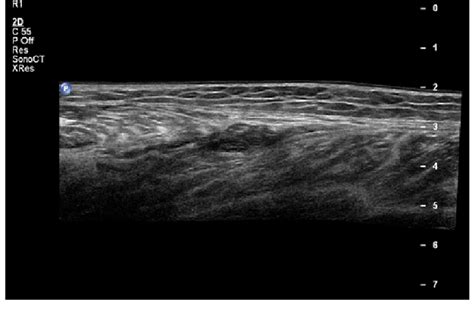 Medial gastrocnemius tendon rupture, coagulation phase. Appearance is... | Download Scientific ...