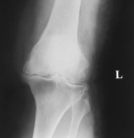 Osteoarthritis of the knee | Radiology Reference Article | Radiopaedia.org