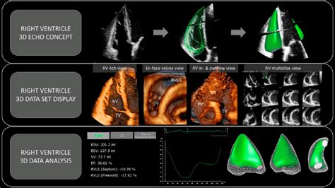 3D echocardiographic assessment of the RV. (Upper) Standard 2D... | Download Scientific Diagram