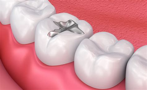 What Dental Fillings Are Best: Gold, Silver, Composite Resin or Ceramic?