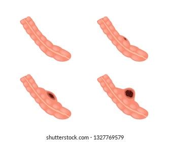 Stomach Intestine Cancer Stages Vector Tumor Stock Vector (Royalty Free) 1327769579 | Shutterstock